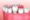 Bottom Teeth Dental Crown